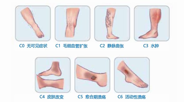 互聯(lián)網(wǎng)洞察助力規(guī)范診療，讓1.2億患者夏天不懼“蚯蚓腿”